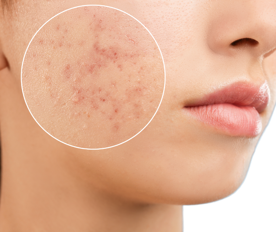 acne-scars
