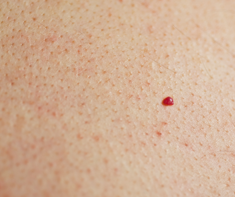 cherry_angiomas