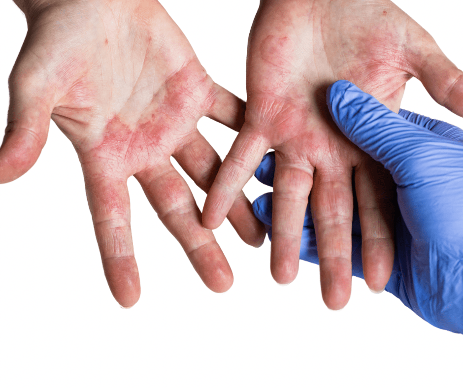 Dermatitis