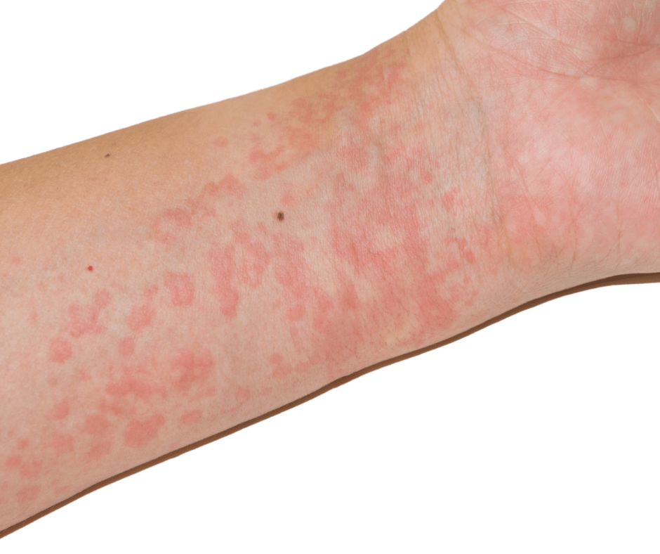 hives