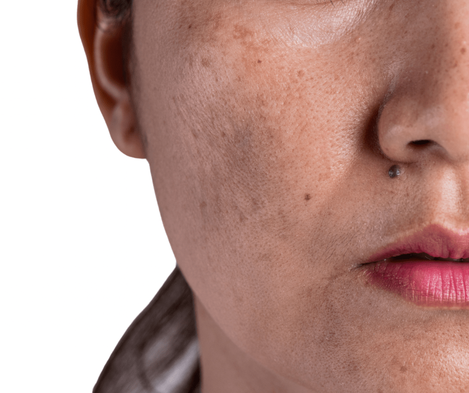 melasma