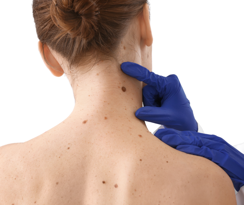 moles