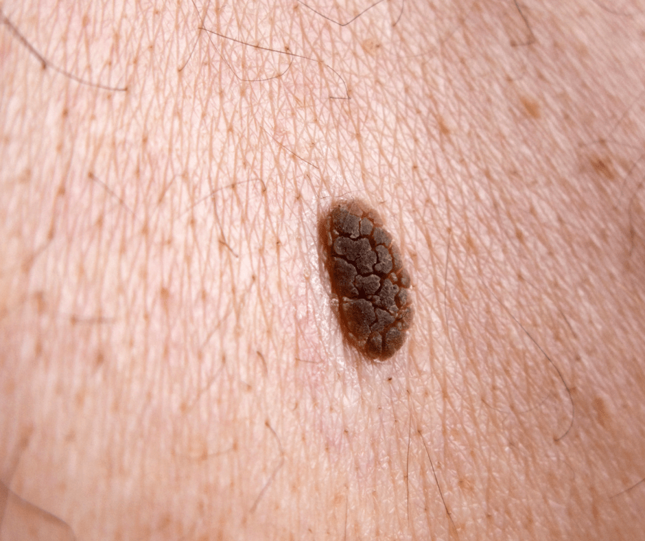 seborrheicKeratosis