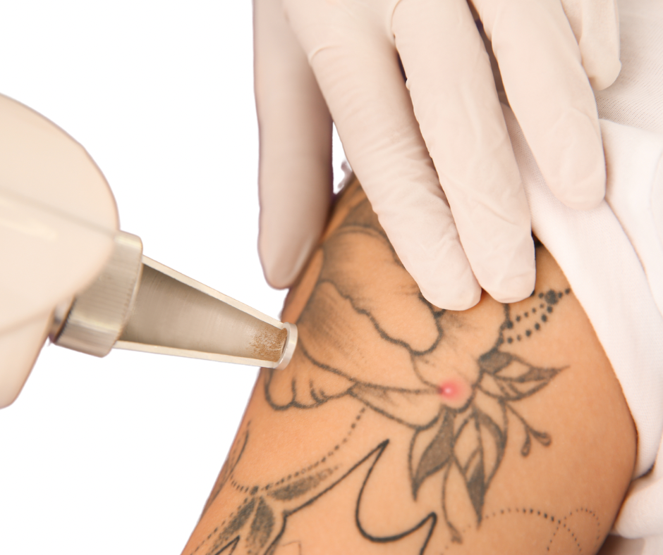 unwantedTattoo