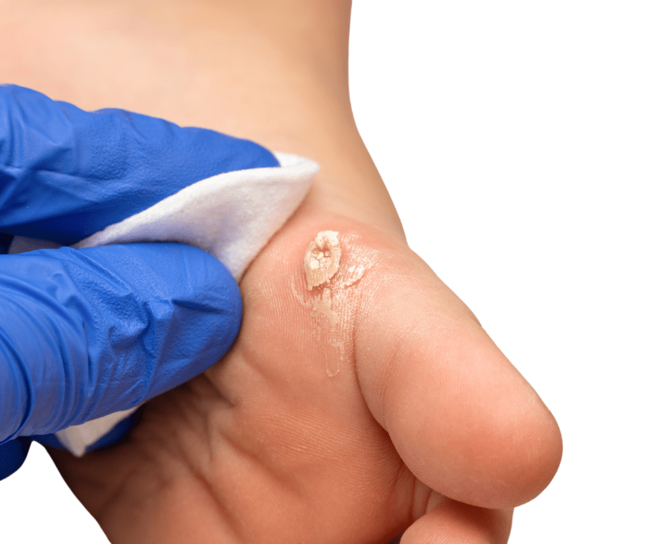 warts